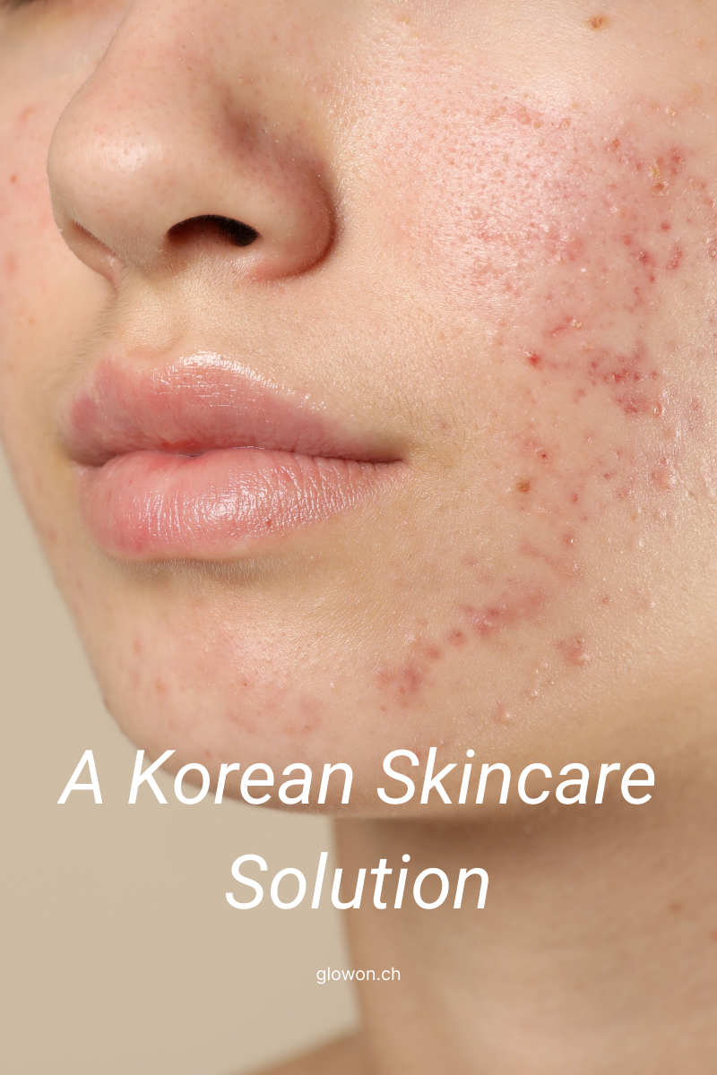 Acne with Lesimo: A Korean skincare solution